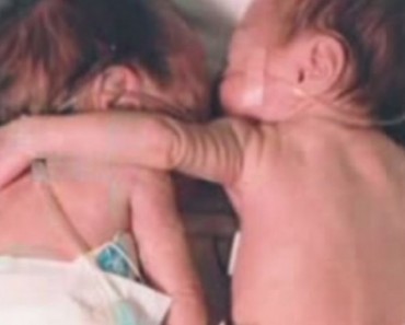 After Being Born Prematurely, This Baby Was On The Verge Of Dying! What The Doctors Did To Save Her Left Everyone Speechless