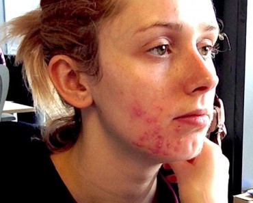 Her Acne Used To Be So Severe That People Would Ask Her If Someone Hit Her Face! The Way She Looks Acne Free Left Everyone Speechless