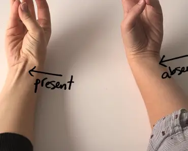 Does Your Tendon Protrude Out Of Your Wrist Like That. If It Does, It Means THIS..